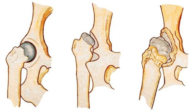 Loạn sản xương hông là nguyên nhân gây bệnh coxarthrosis thứ phát