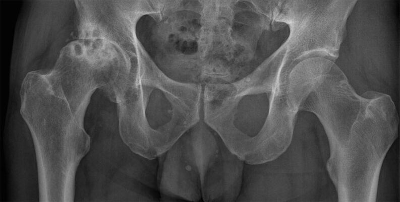 Viêm khớp háng giai đoạn 3 trên X-quang
