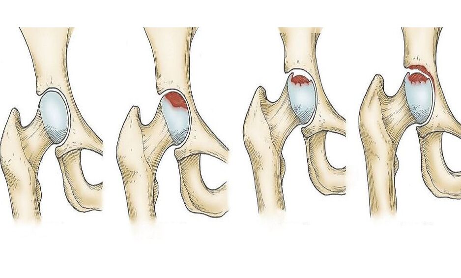 sự tiến triển của đau hông
