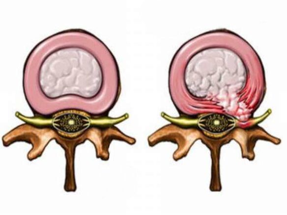 Đĩa lành mạnh và không lành mạnh