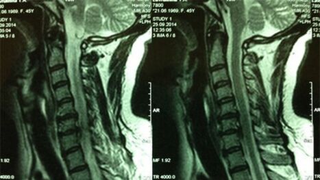 MRI của bộ phận cổ tử cung