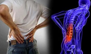 Những lý do cho sự phát triển của bệnh xương khớp thắt lưng