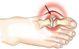 Viêm khớp giữa ngón cái và bàn chân trong bệnh viêm khớp