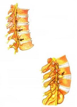 minh họa về hoại tử xương của cột sống