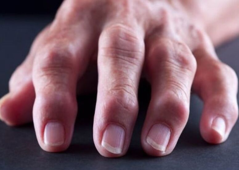viêm khớp dạng thấp là nguyên nhân gây đau ở các khớp ngón tay
