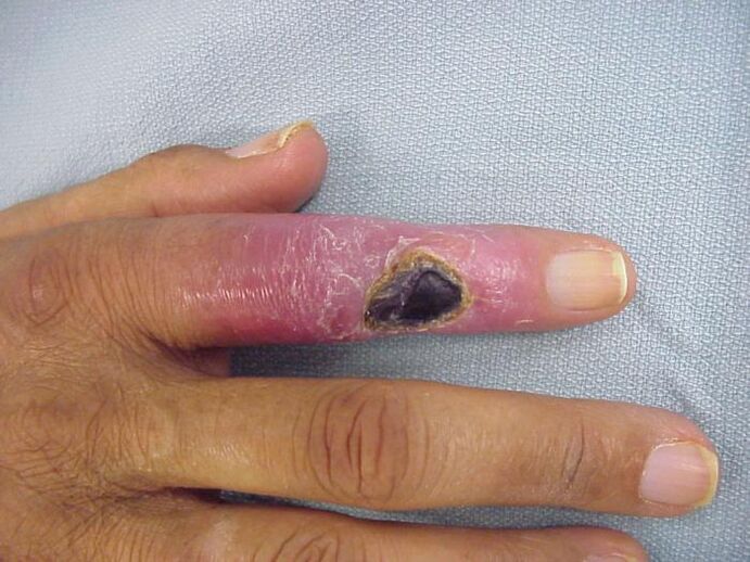 viêm tủy xương là nguyên nhân gây đau ở các khớp ngón tay
