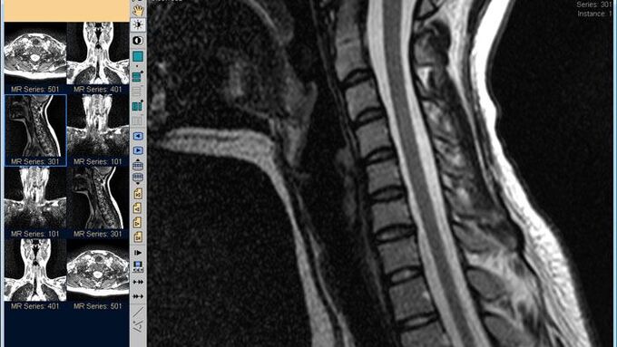 MRI cột sống cổ là phương pháp tốt nhất để chẩn đoán đau cổ